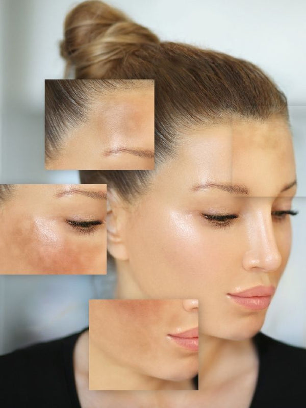 SCARS AND PIGMENTATION