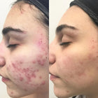 ACNELAK SERUM