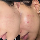 ACNELAK ACNE OIL AND CONTROL FACE WASH